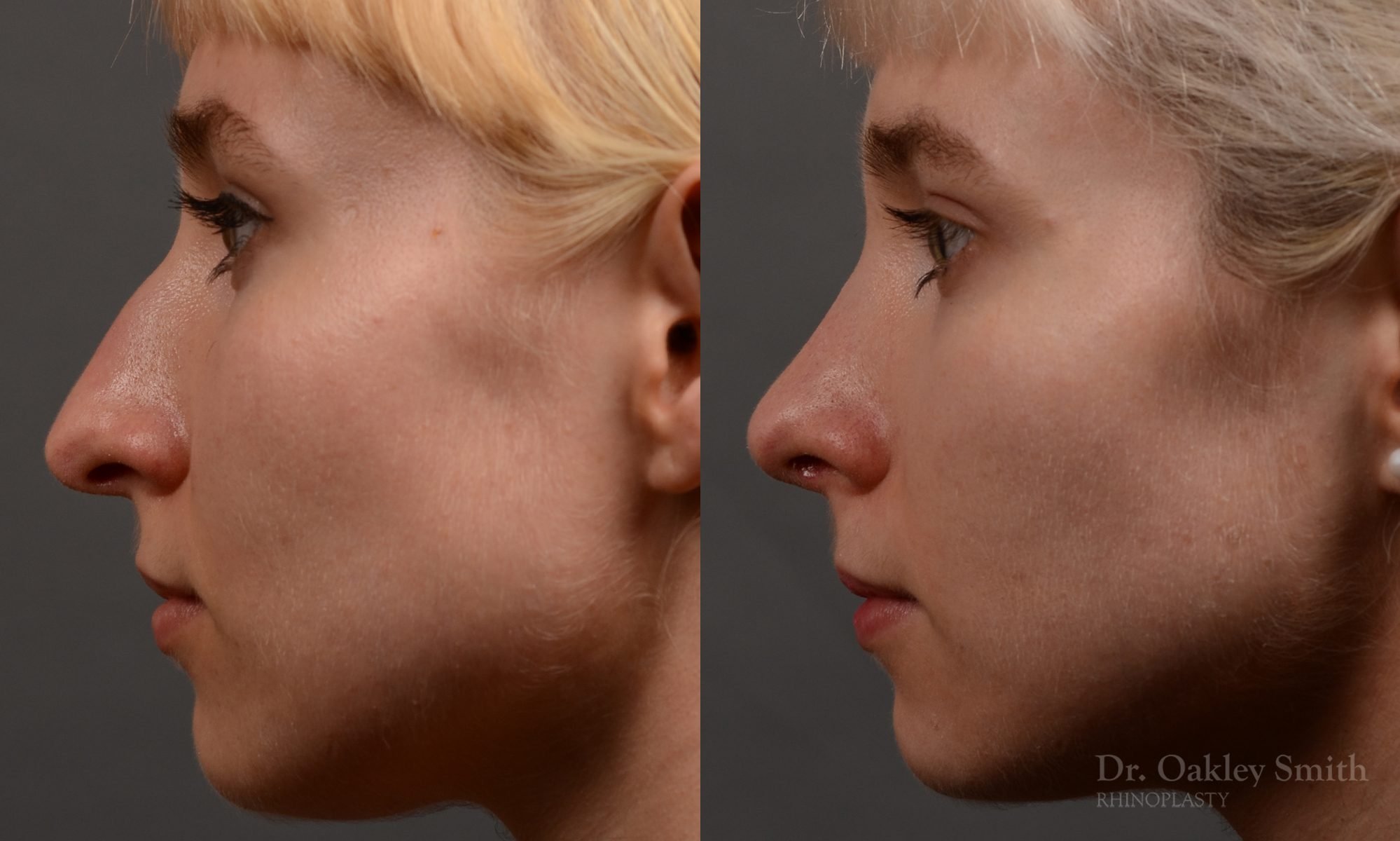 398 - Expert Rhinoplasty nose job surgery to reduce the size of this womans nose.