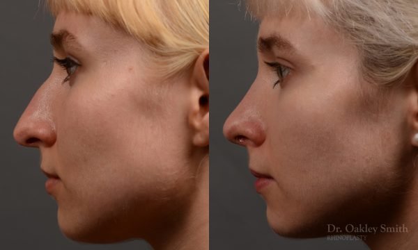 398 - Expert Rhinoplasty nose job surgery to reduce the size of this womans nose.