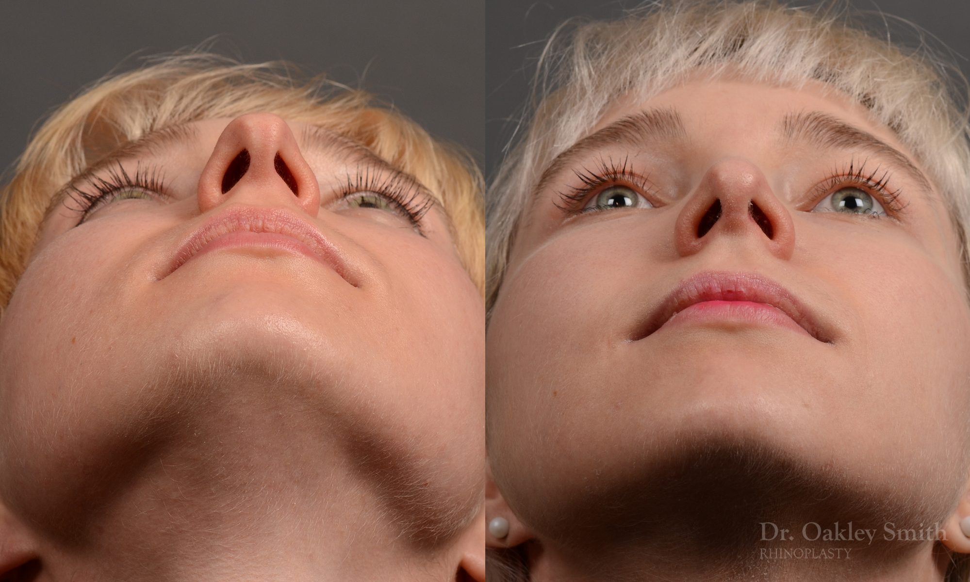 398 - Expert Rhinoplasty nose job surgery to reduce the size of this womans nose.