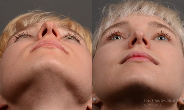 398 - Expert Rhinoplasty nose job surgery to reduce the size of this womans nose.