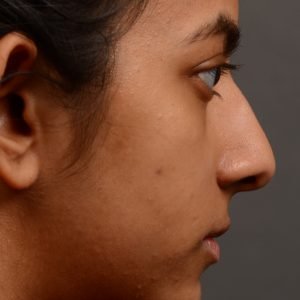 399 - Expert Rhinoplasty nose job surgery to reduce the size of this womans nose.