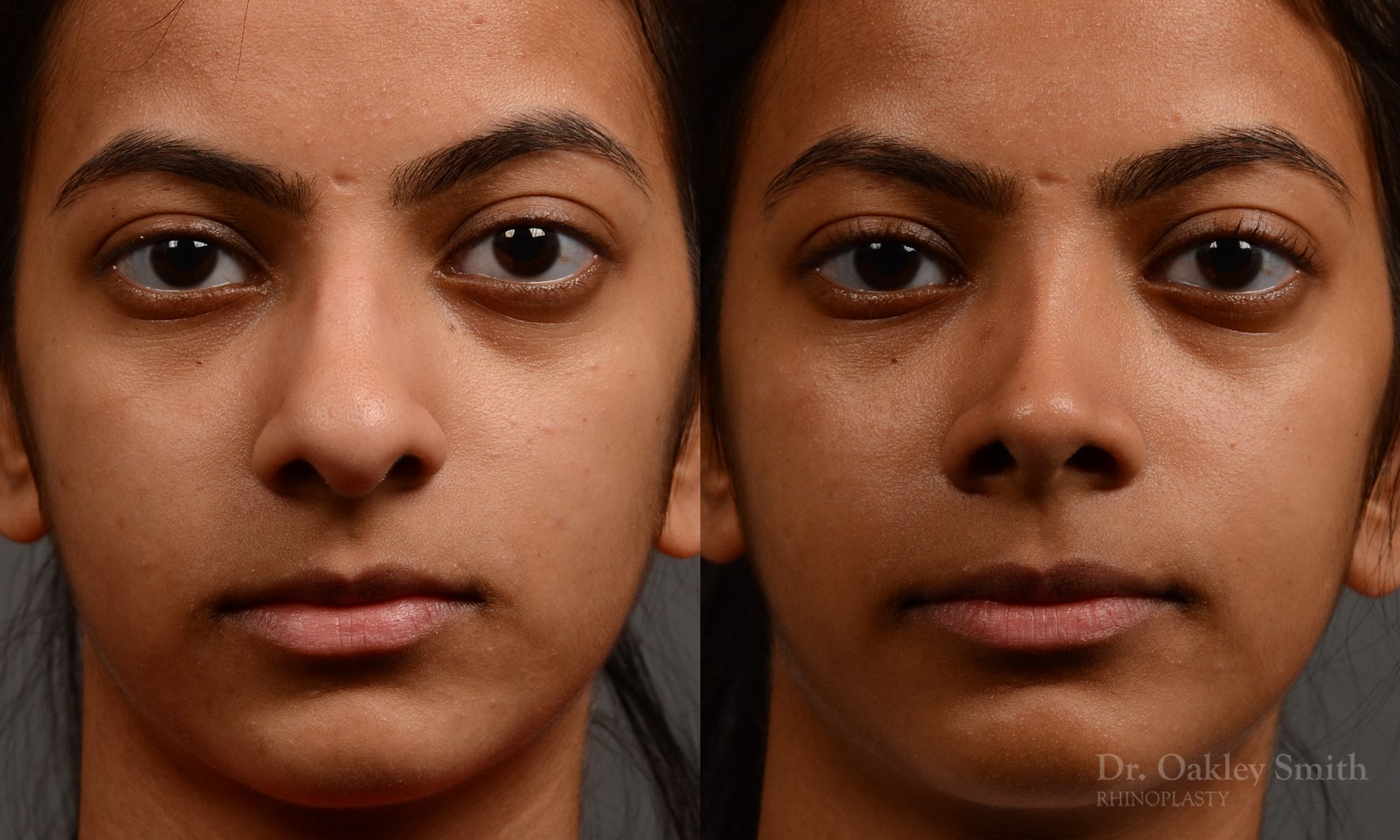 399 - Expert Rhinoplasty nose job surgery to reduce the size of this womans nose.