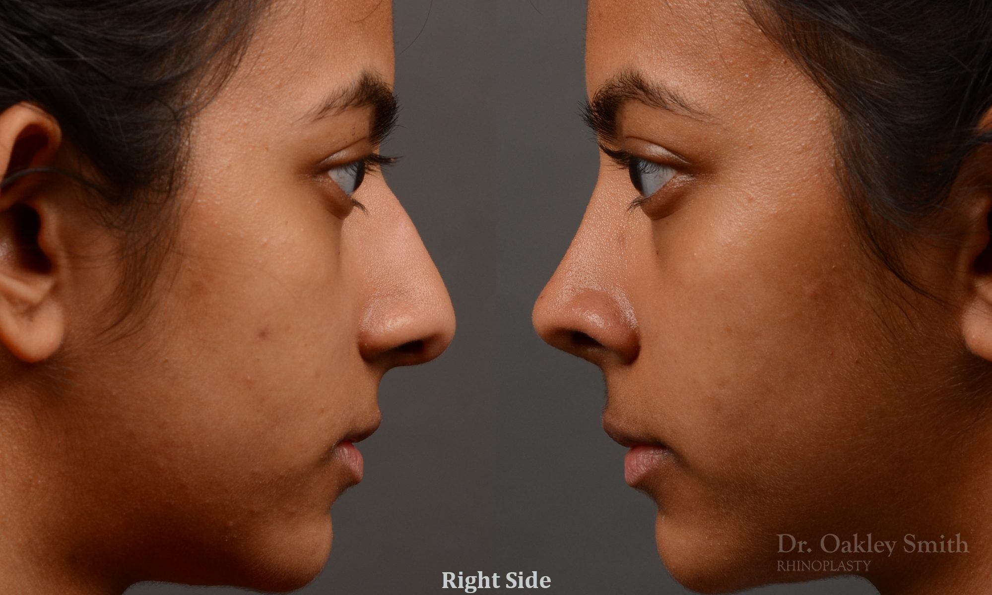 399 - Expert Rhinoplasty nose job surgery to reduce the size of this womans nose.