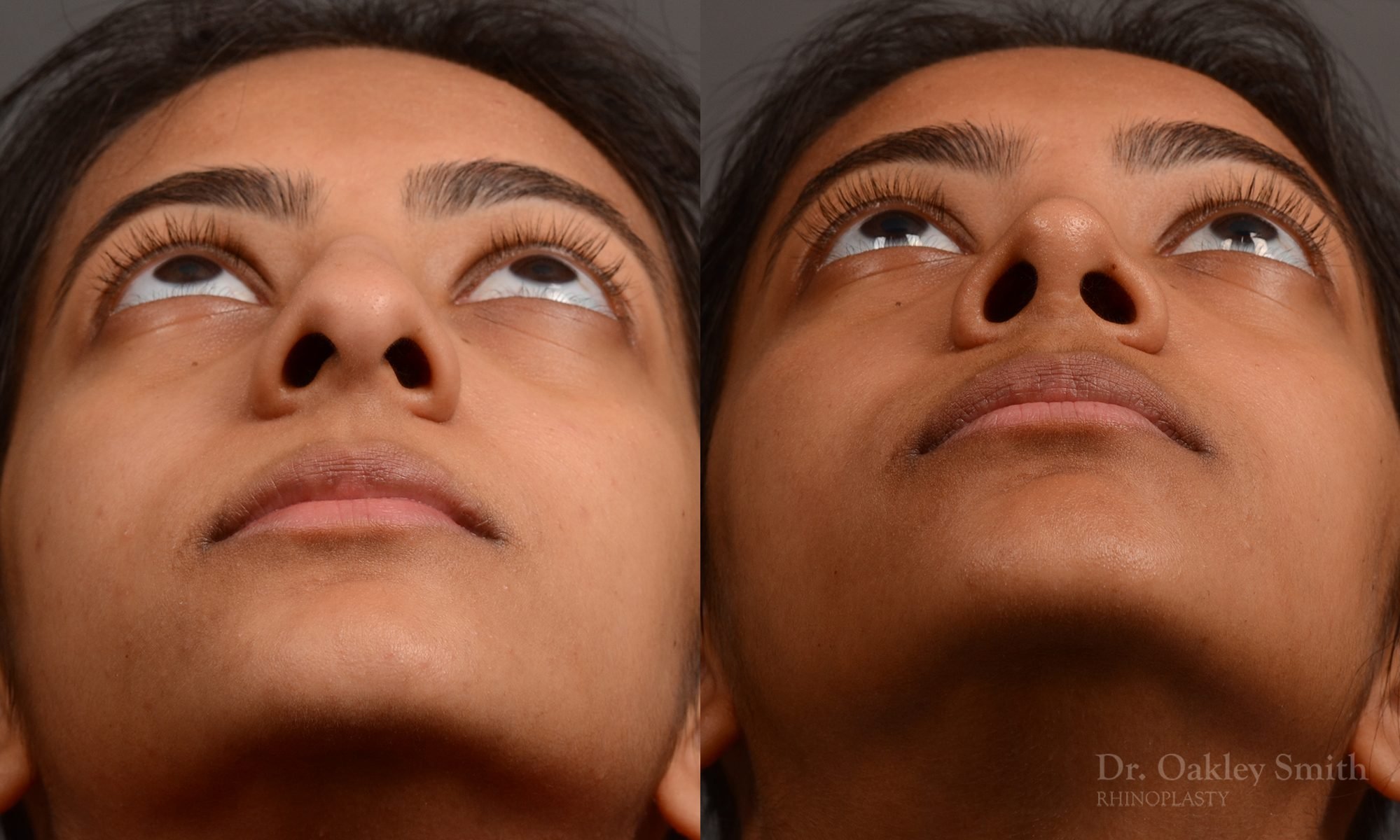 399 - Expert Rhinoplasty nose job surgery to reduce the size of this womans nose.