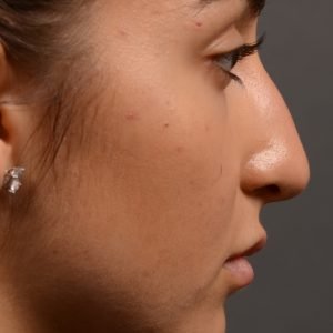 400 - Expert Rhinoplasty nose job surgery to reduce the size of this womans nose.