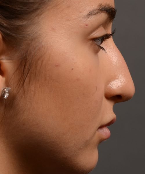400 - Expert Rhinoplasty nose job surgery to reduce the size of this womans nose.