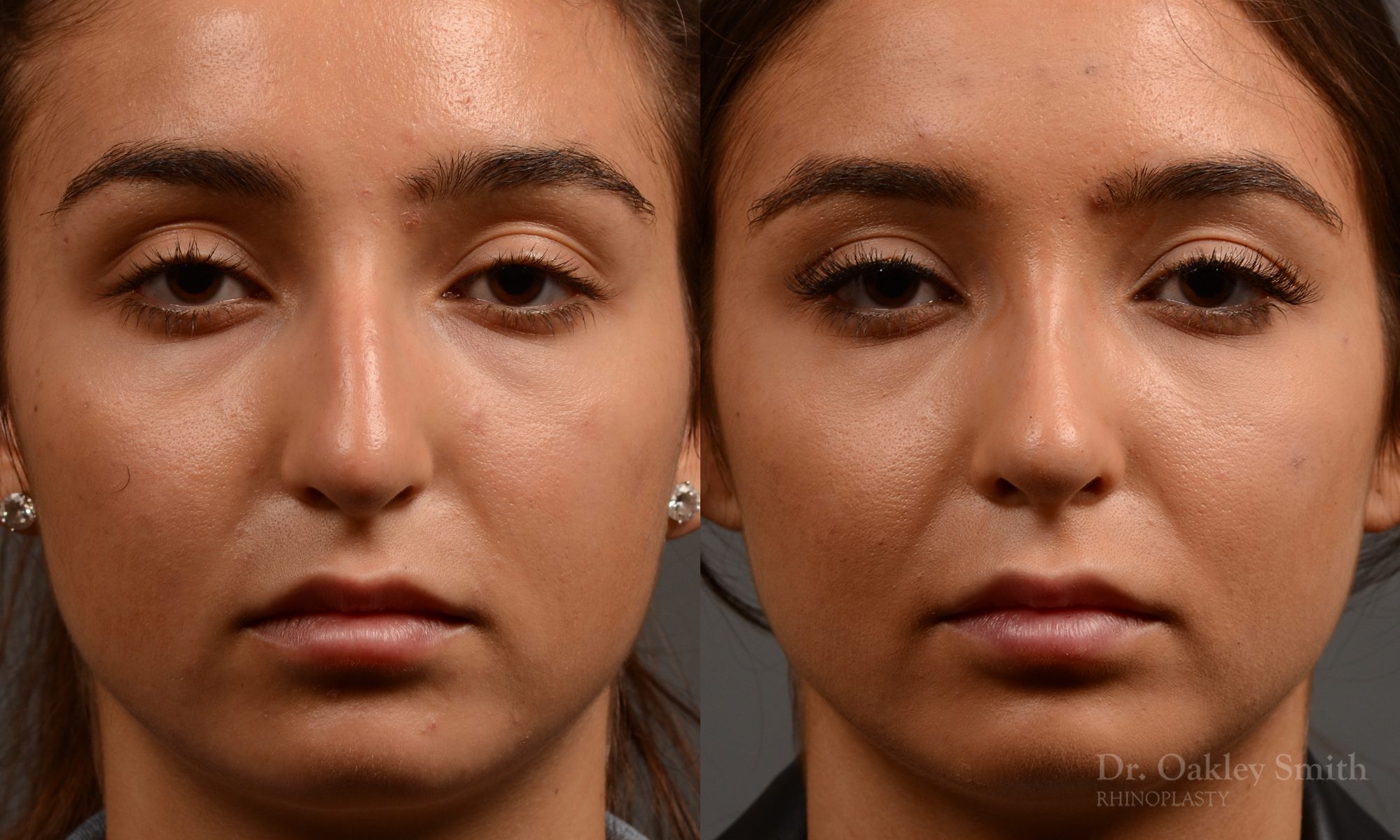 400 - Expert Rhinoplasty nose job surgery to reduce the size of this womans nose.