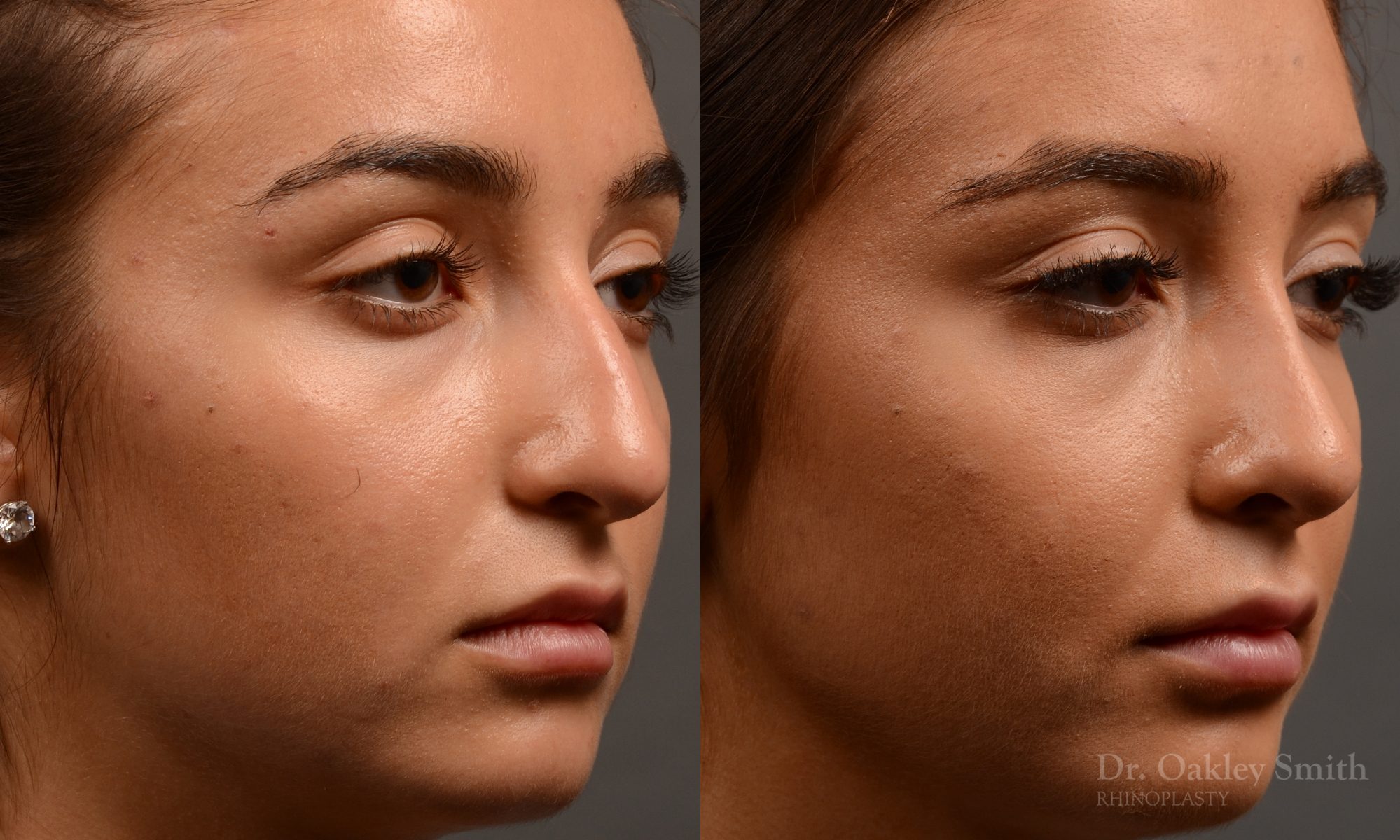 400 - Expert Rhinoplasty nose job surgery to reduce the size of this womans nose.
