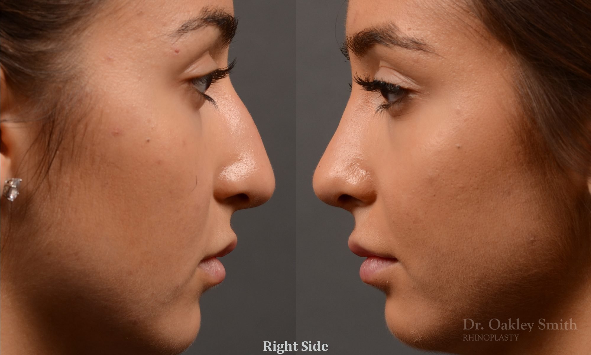 400 - Expert Rhinoplasty nose job surgery to reduce the size of this womans nose.