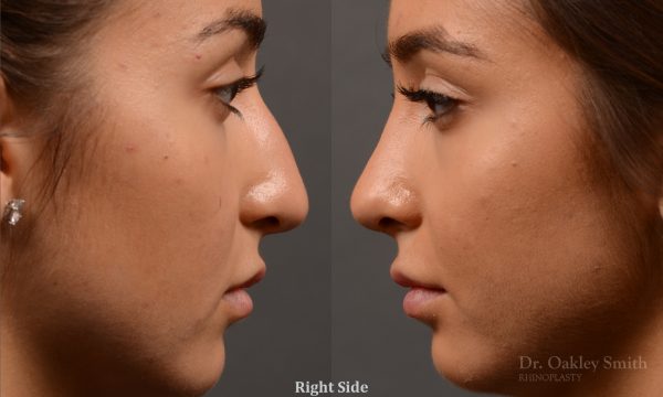 400 - Expert Rhinoplasty nose job surgery to reduce the size of this womans nose.