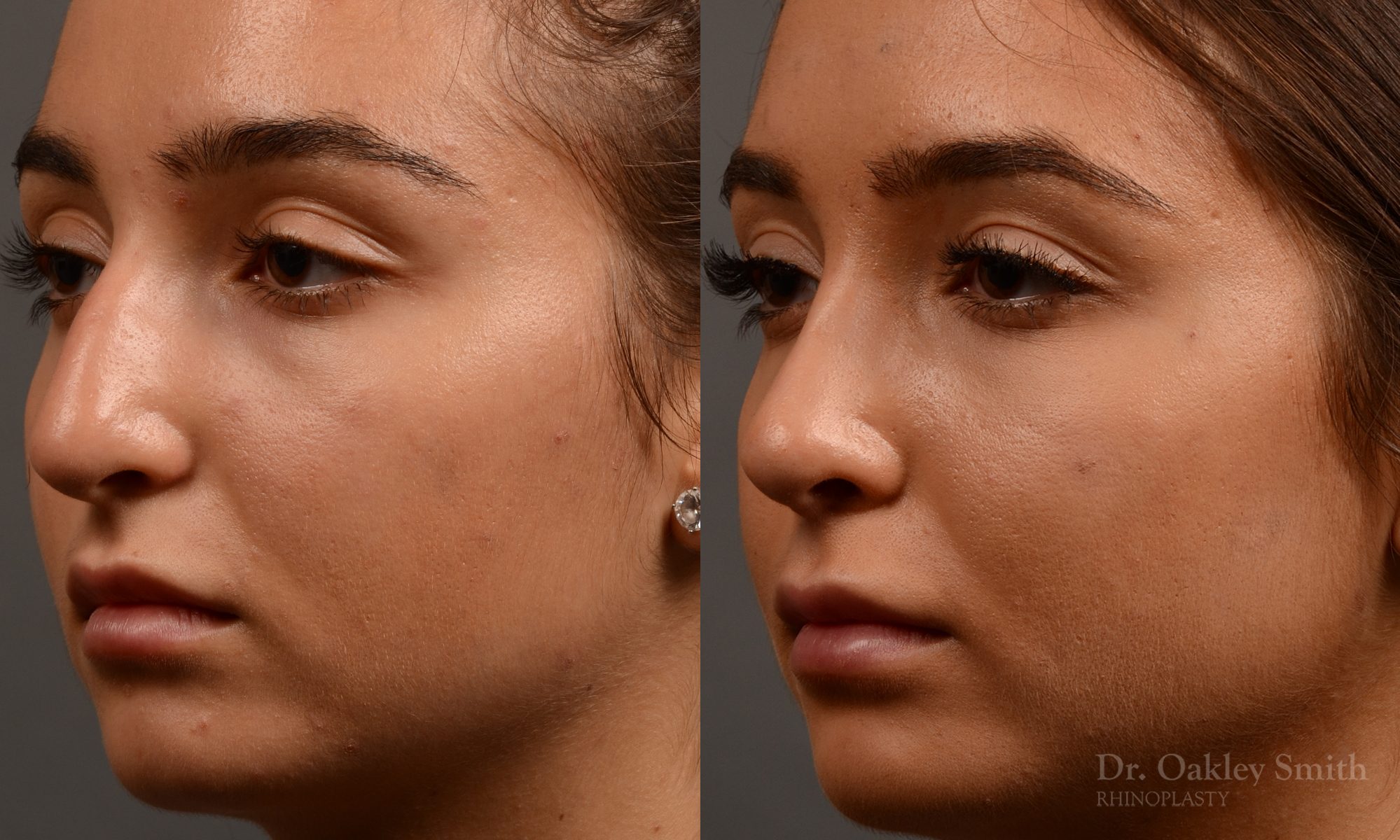 400 - Expert Rhinoplasty nose job surgery to reduce the size of this womans nose.