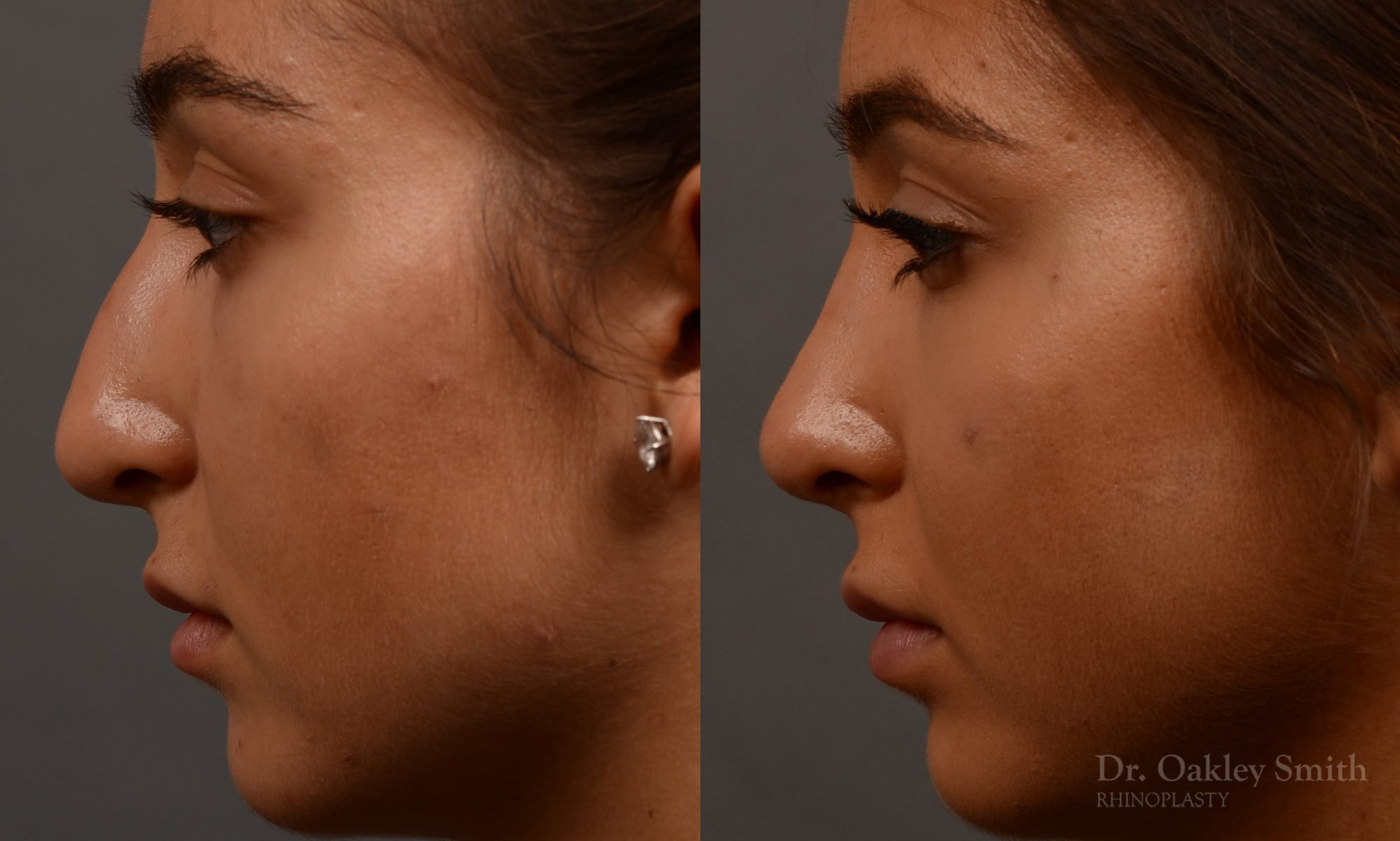400 - Expert Rhinoplasty nose job surgery to reduce the size of this womans nose.