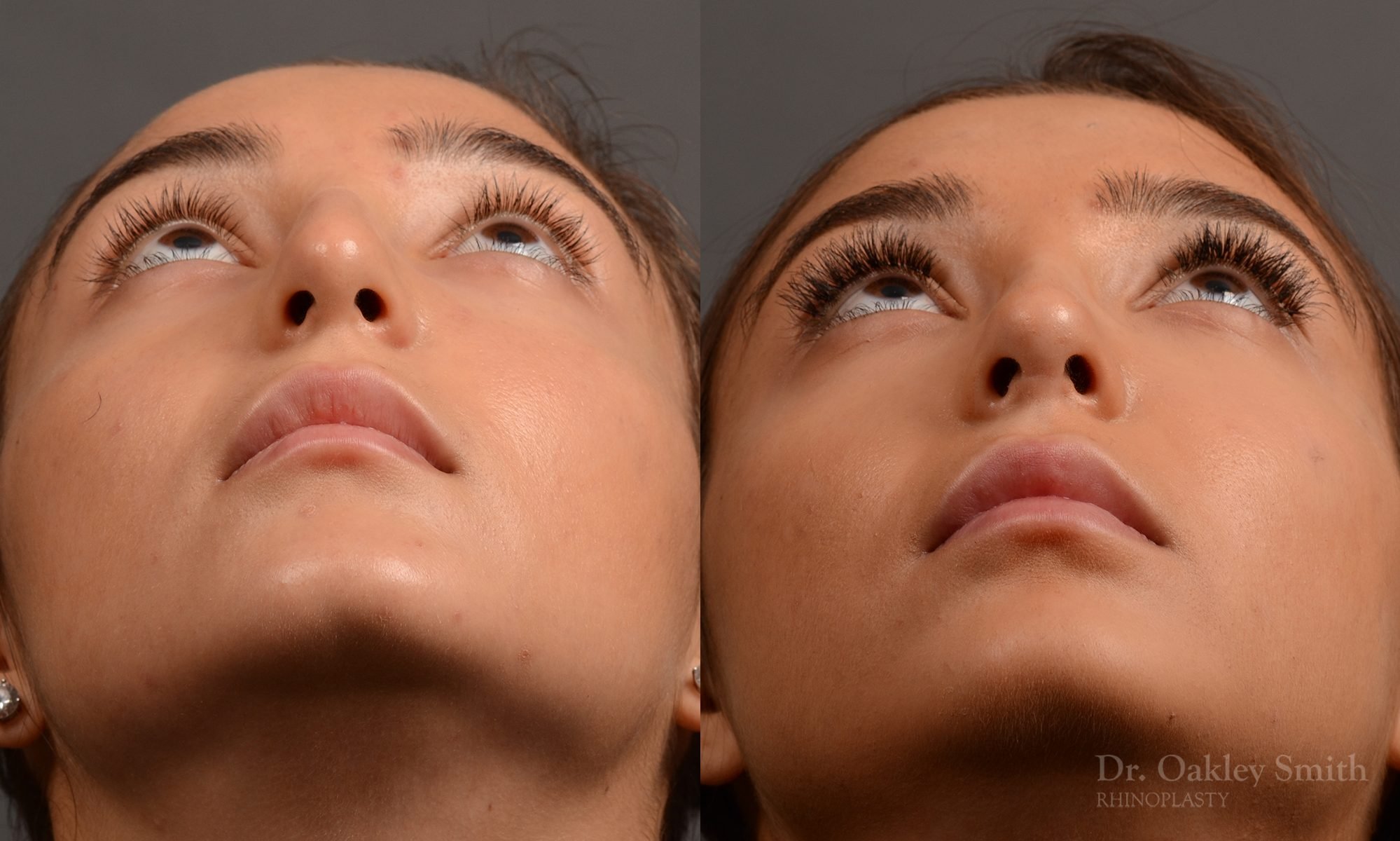 400 - Expert Rhinoplasty nose job surgery to reduce the size of this womans nose.