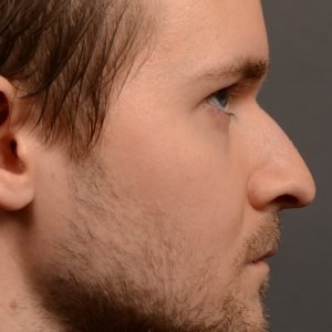 401 male rhinoplasty dr. oakley smith