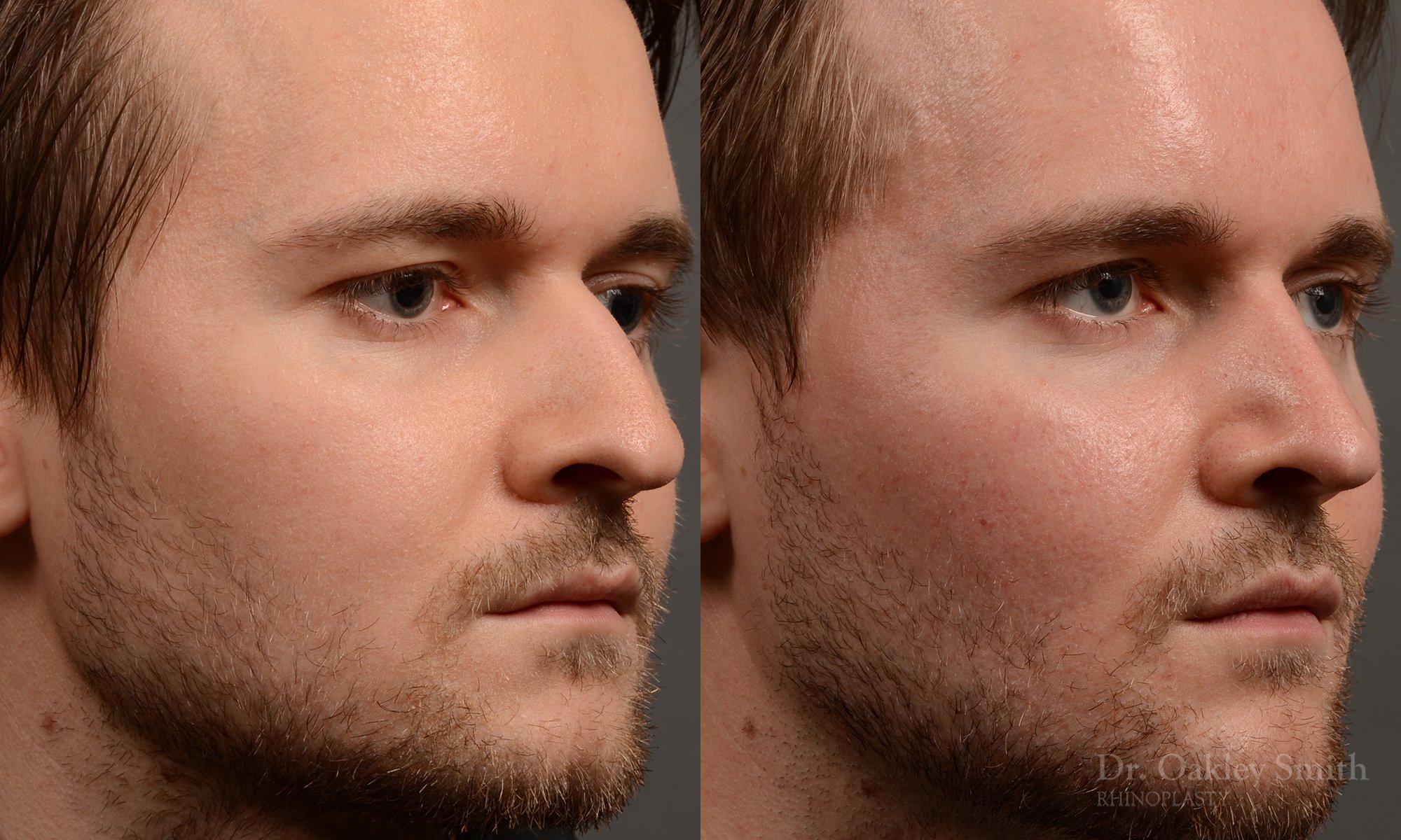401 male rhinoplasty dr. oakley smith
