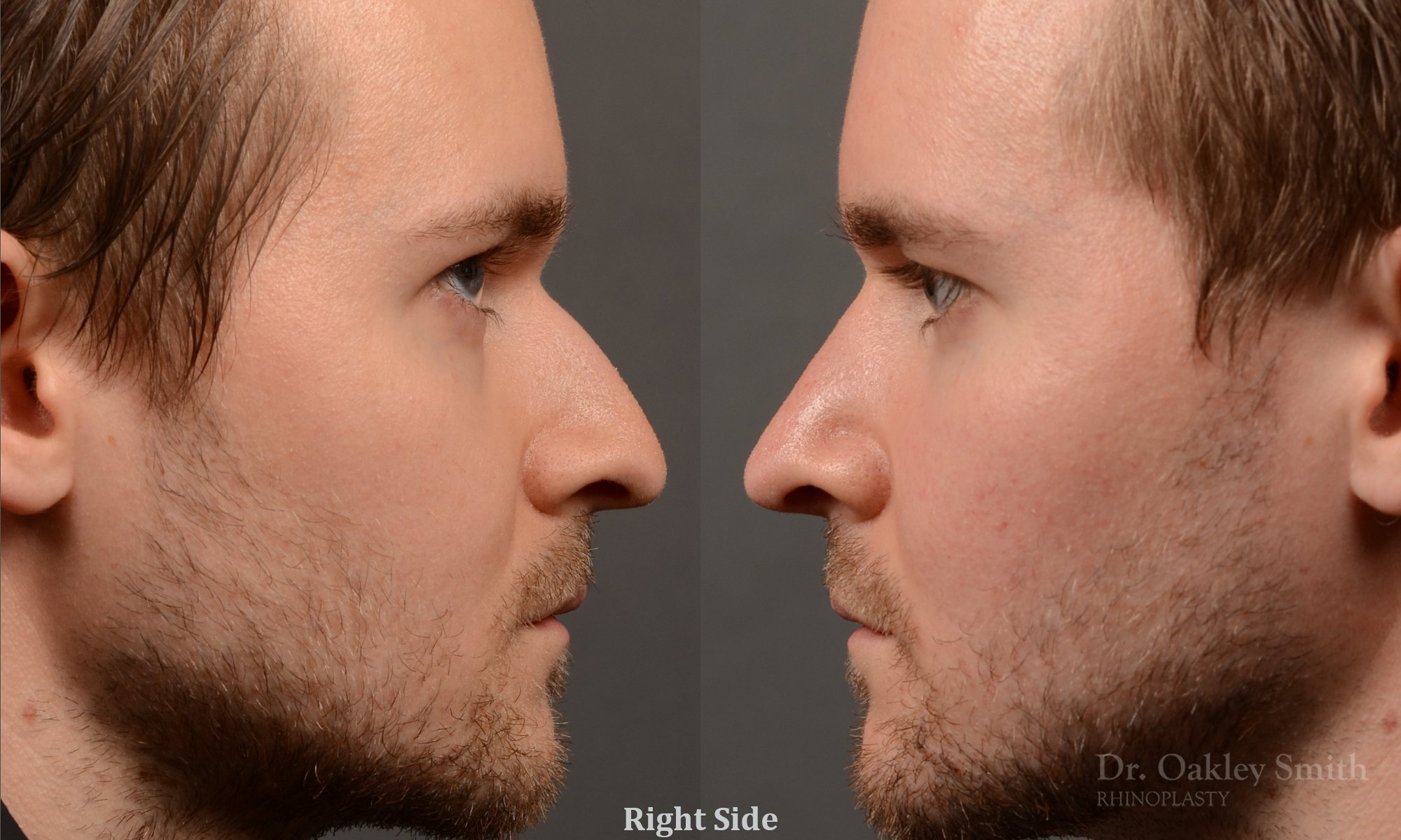 401 male rhinoplasty dr. oakley smith