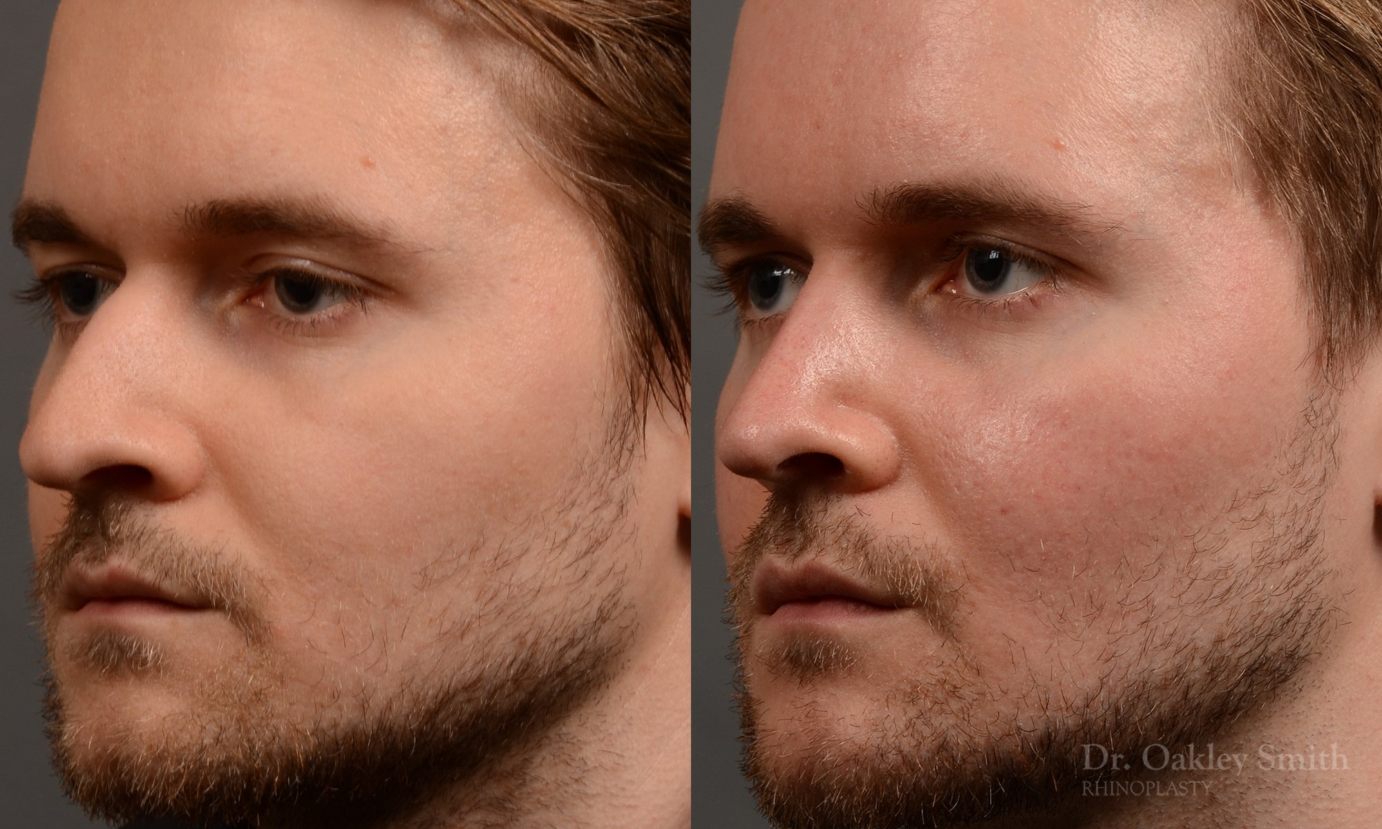 401 male rhinoplasty dr. oakley smith