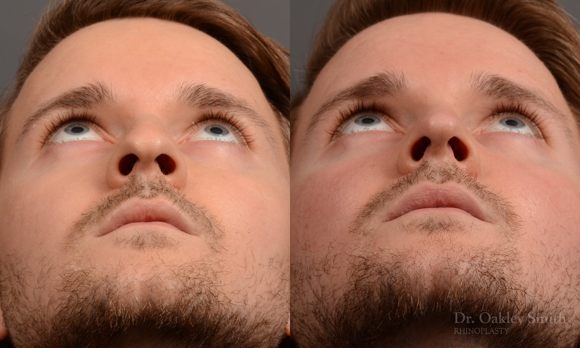 401 male rhinoplasty dr. oakley smith