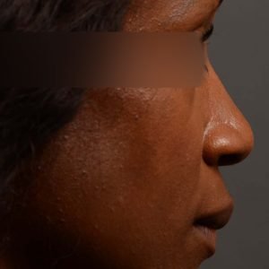 402 rhinoplasty nose job, wide base, dr. oakley smith, toronto