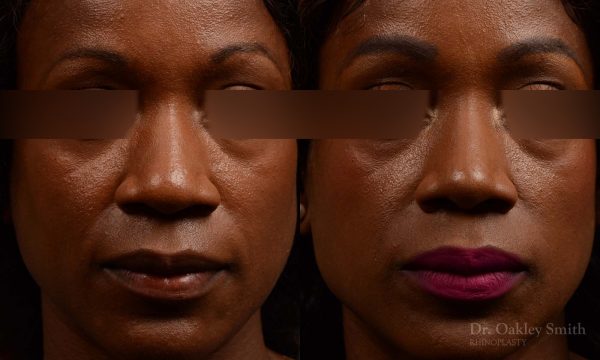 402 rhinoplasty nose job, wide base, dr. oakley smith, toronto
