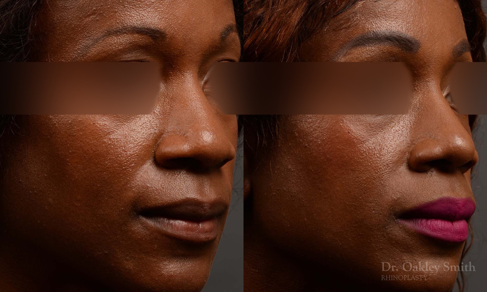 402 rhinoplasty nose job, wide base, dr. oakley smith, toronto