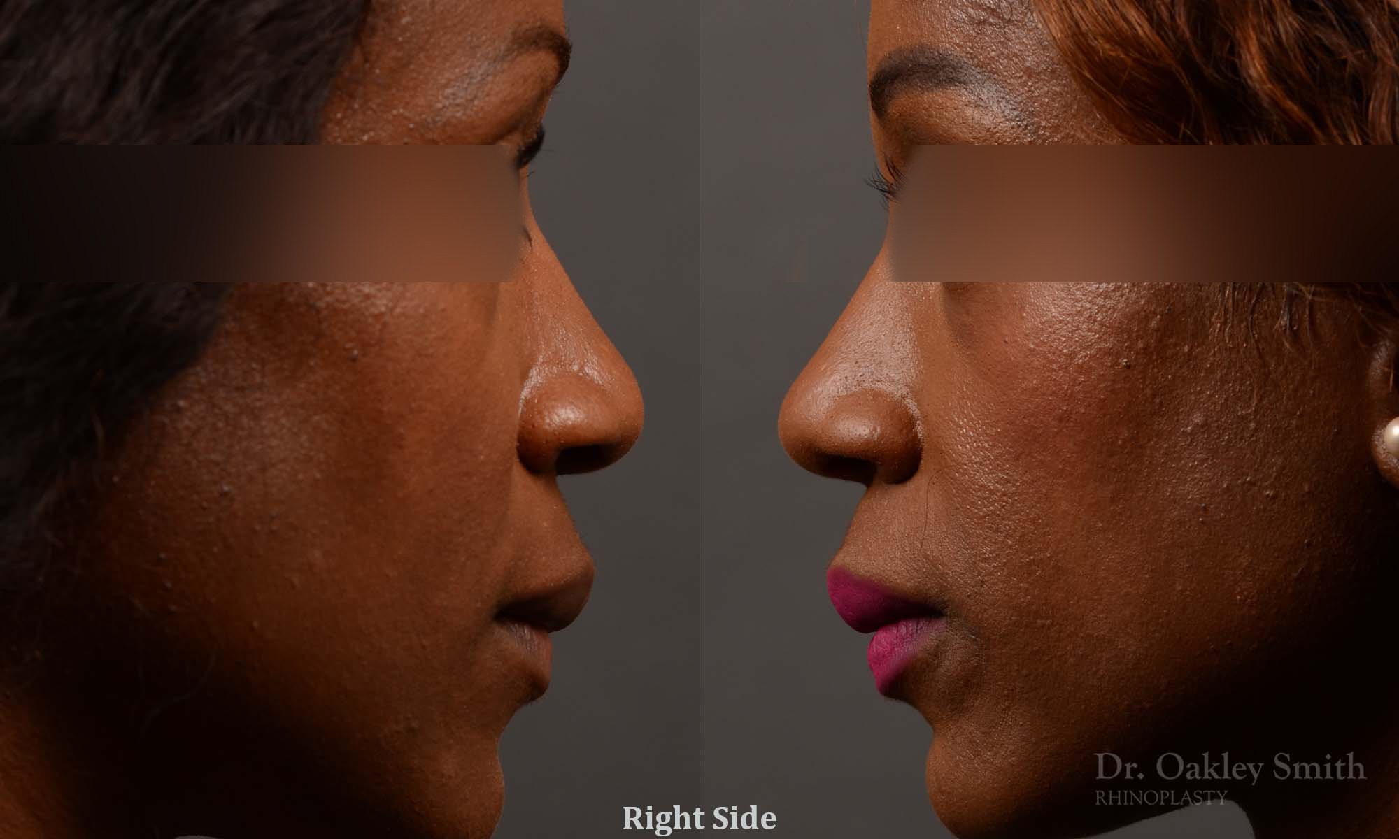 402 rhinoplasty nose job, wide base, dr. oakley smith, toronto