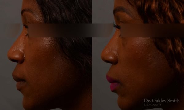 402 rhinoplasty nose job, wide base, dr. oakley smith, toronto