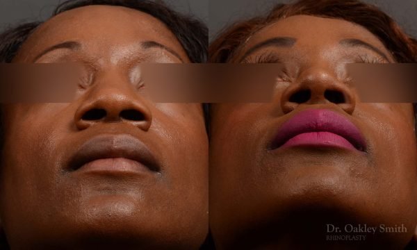 402 rhinoplasty nose job, wide base, dr. oakley smith, toronto