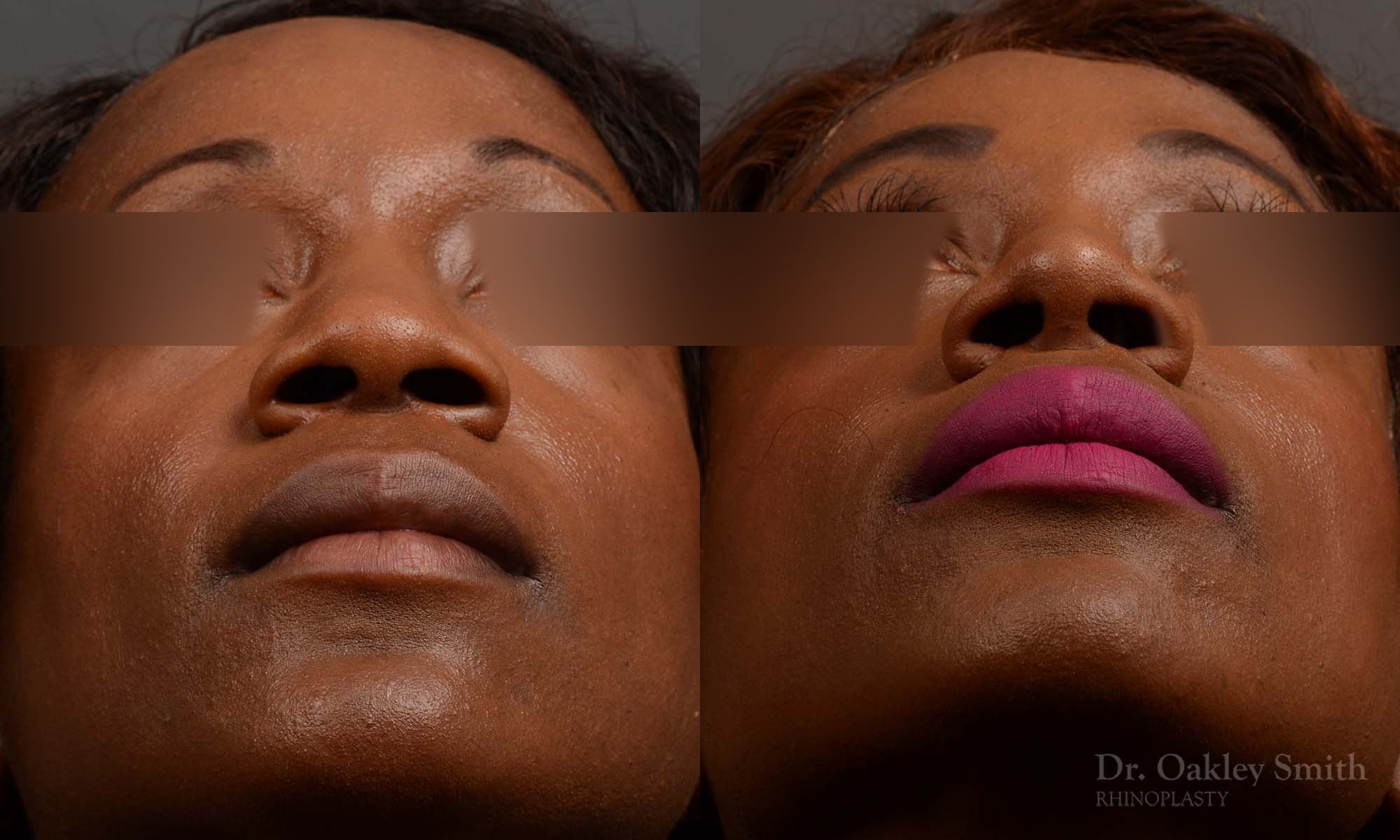 402 rhinoplasty nose job, wide base, dr. oakley smith, toronto