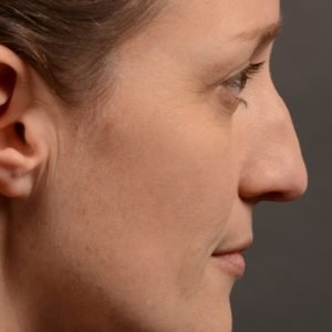 404 hump reduction rhinoplasty - dr. Oakley Smith - top toronto nose job surgeon