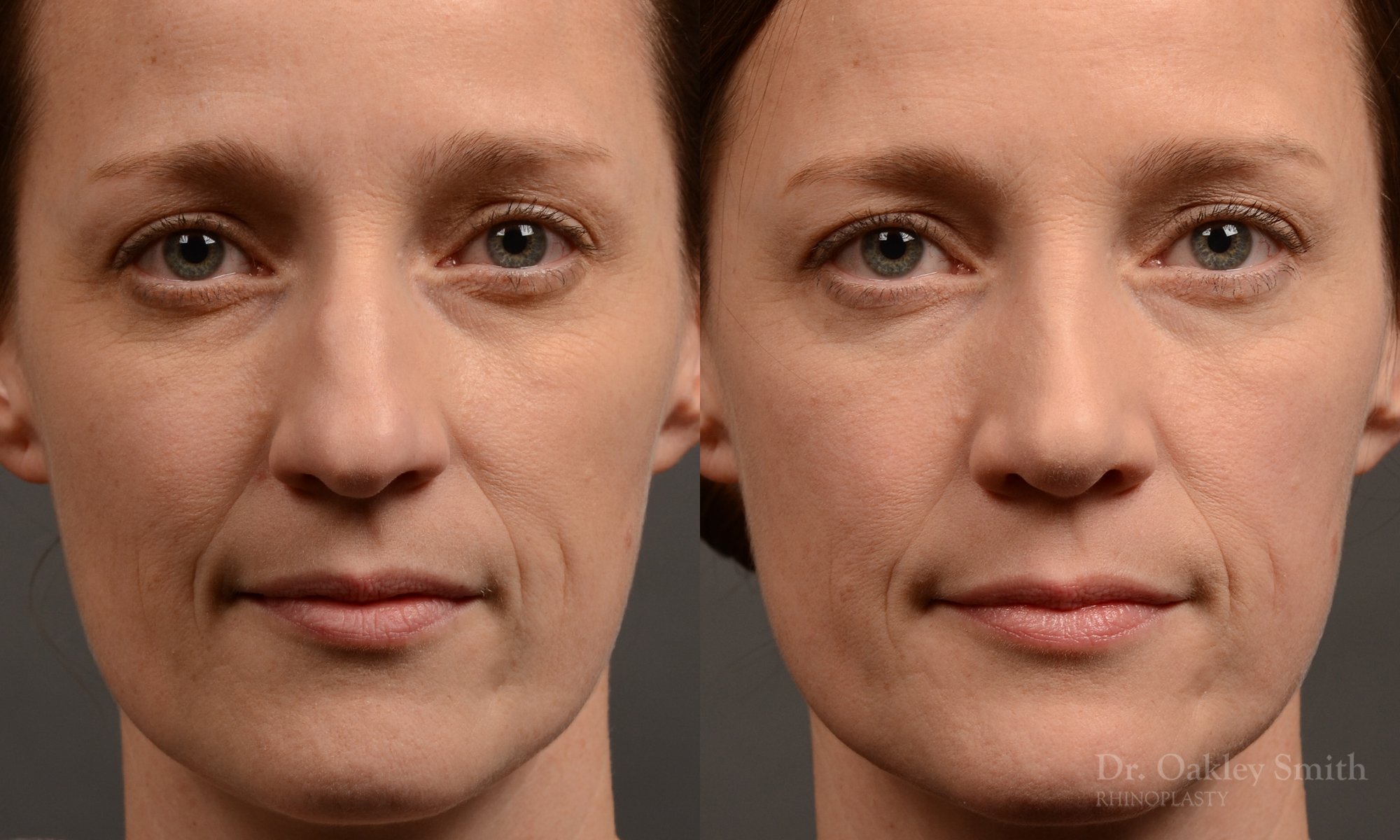404 hump reduction rhinoplasty - dr. Oakley Smith - top toronto nose job surgeon