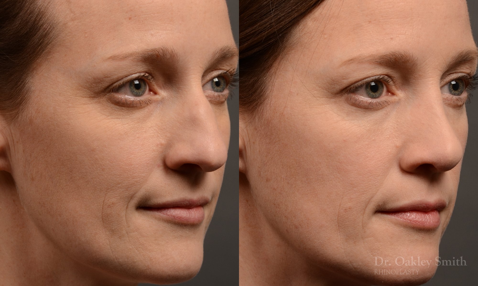 404 hump reduction rhinoplasty - dr. Oakley Smith - top toronto nose job surgeon