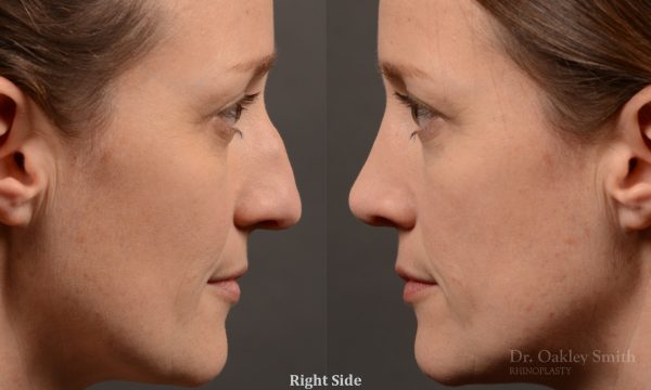 404 hump reduction rhinoplasty - dr. Oakley Smith - top toronto nose job surgeon