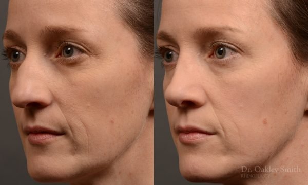 404 hump reduction rhinoplasty - dr. Oakley Smith - top toronto nose job surgeon