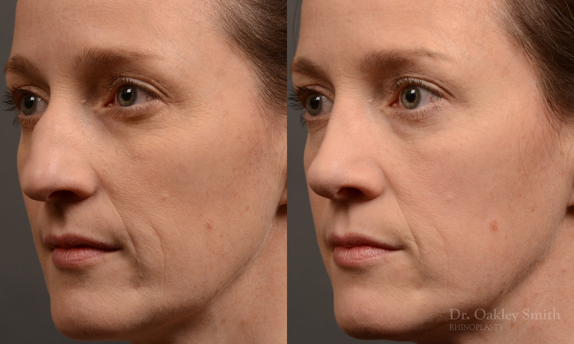 404 hump reduction rhinoplasty - dr. Oakley Smith - top toronto nose job surgeon