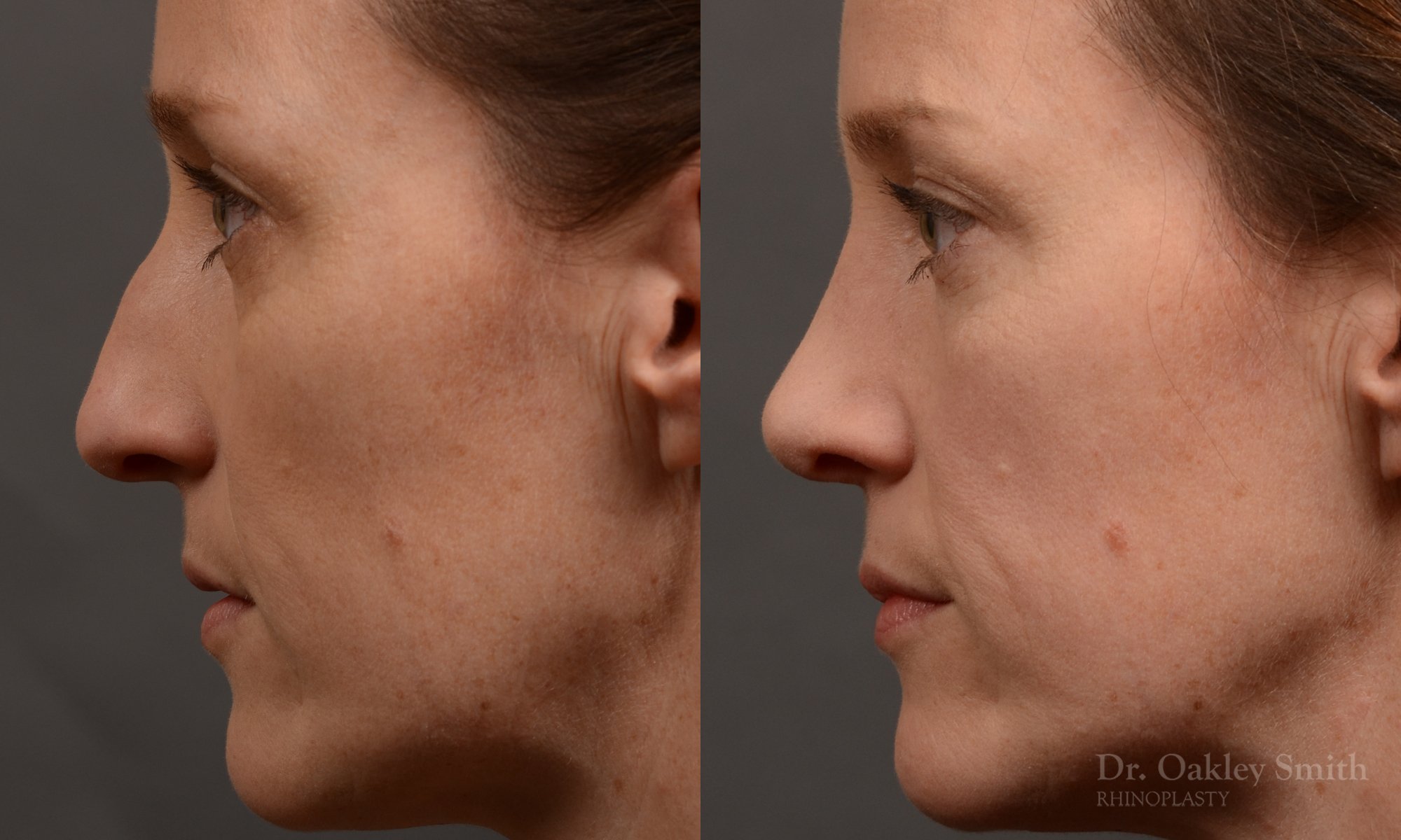 404 hump reduction rhinoplasty - dr. Oakley Smith - top toronto nose job surgeon
