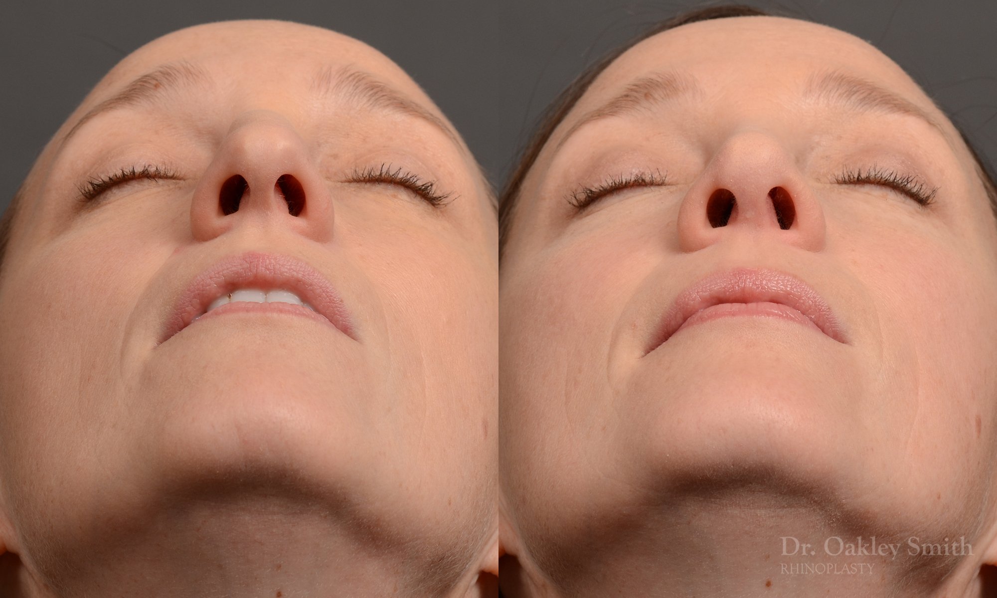 404 hump reduction rhinoplasty - dr. Oakley Smith - top toronto nose job surgeon