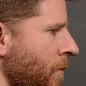 379 - Expert toronto rhinoplasty surgeon - dr. oakley smith - hump reduction, overall size reduction