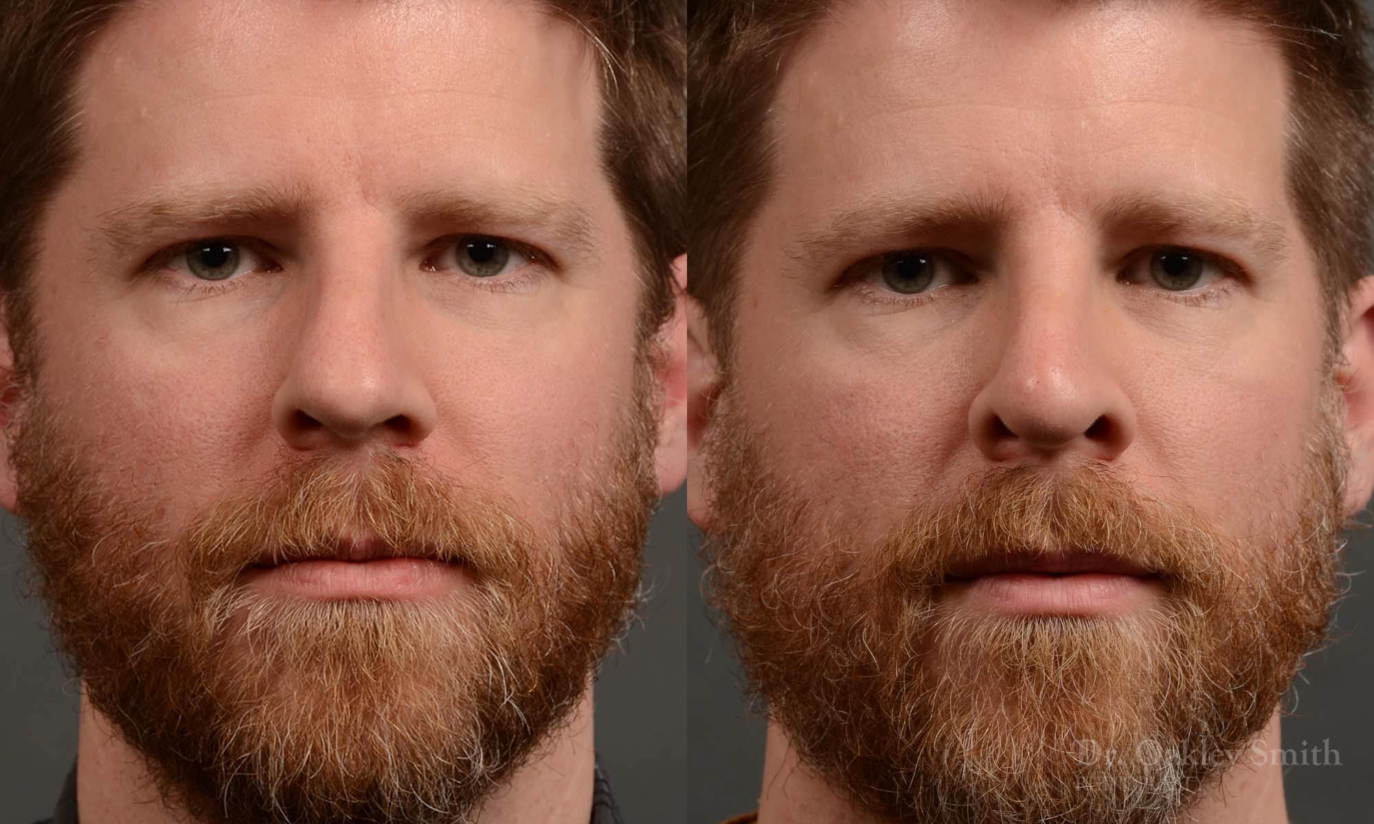 379 - Expert toronto rhinoplasty surgeon - dr. oakley smith - hump reduction, overall size reduction