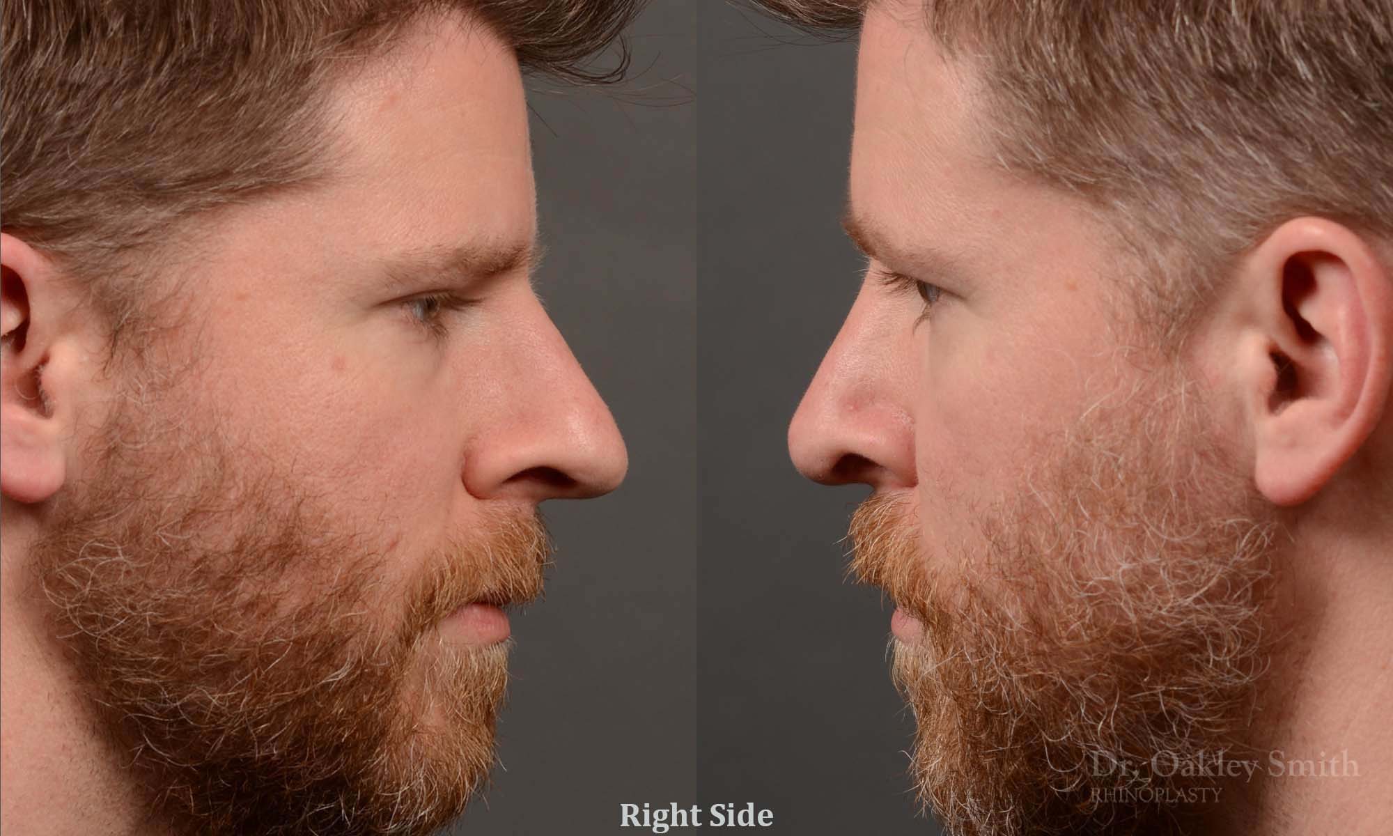 379 - Expert toronto rhinoplasty surgeon - dr. oakley smith - hump reduction, overall size reduction