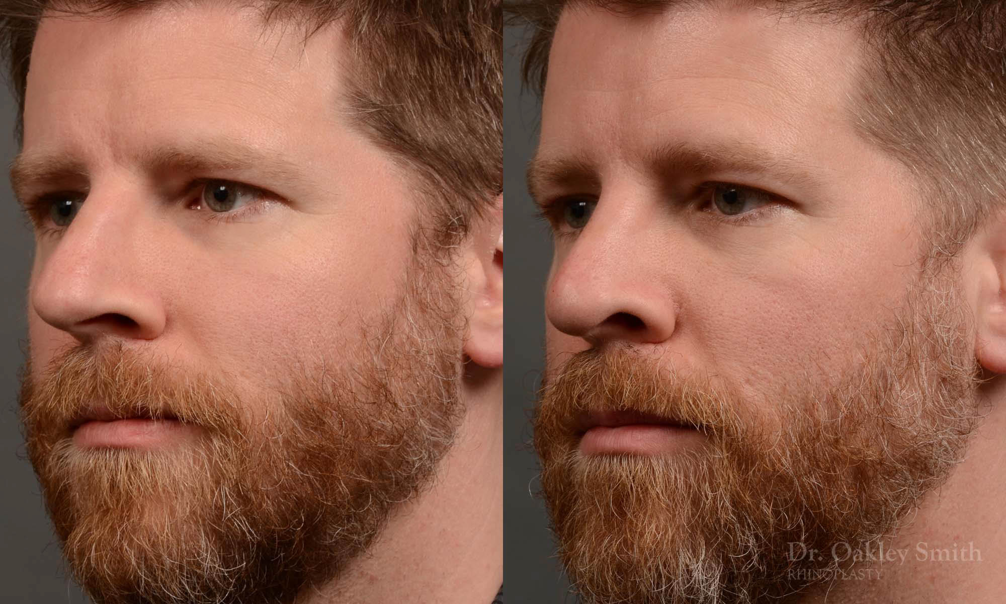 379 - Expert toronto rhinoplasty surgeon - dr. oakley smith - hump reduction, overall size reduction