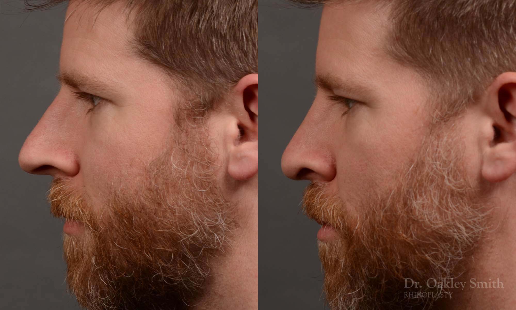 379 - Expert toronto rhinoplasty surgeon - dr. oakley smith - hump reduction, overall size reduction