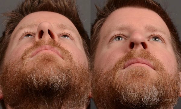 379 - Expert toronto rhinoplasty surgeon - dr. oakley smith - hump reduction, overall size reduction