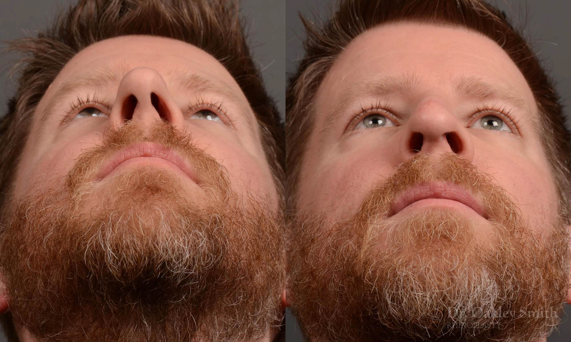 379 - Expert toronto rhinoplasty surgeon - dr. oakley smith - hump reduction, overall size reduction