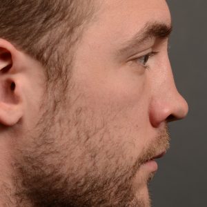 388 - expert toronto rhinoplasty surgery to remove the bulbous tip of this mans nose