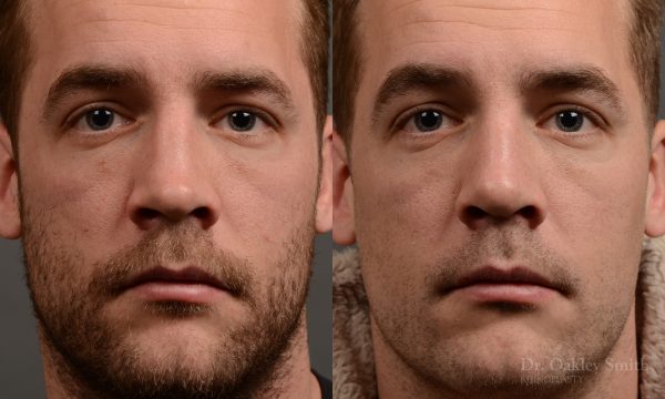 388 - expert toronto rhinoplasty surgery to remove the bulbous tip of this mans nose