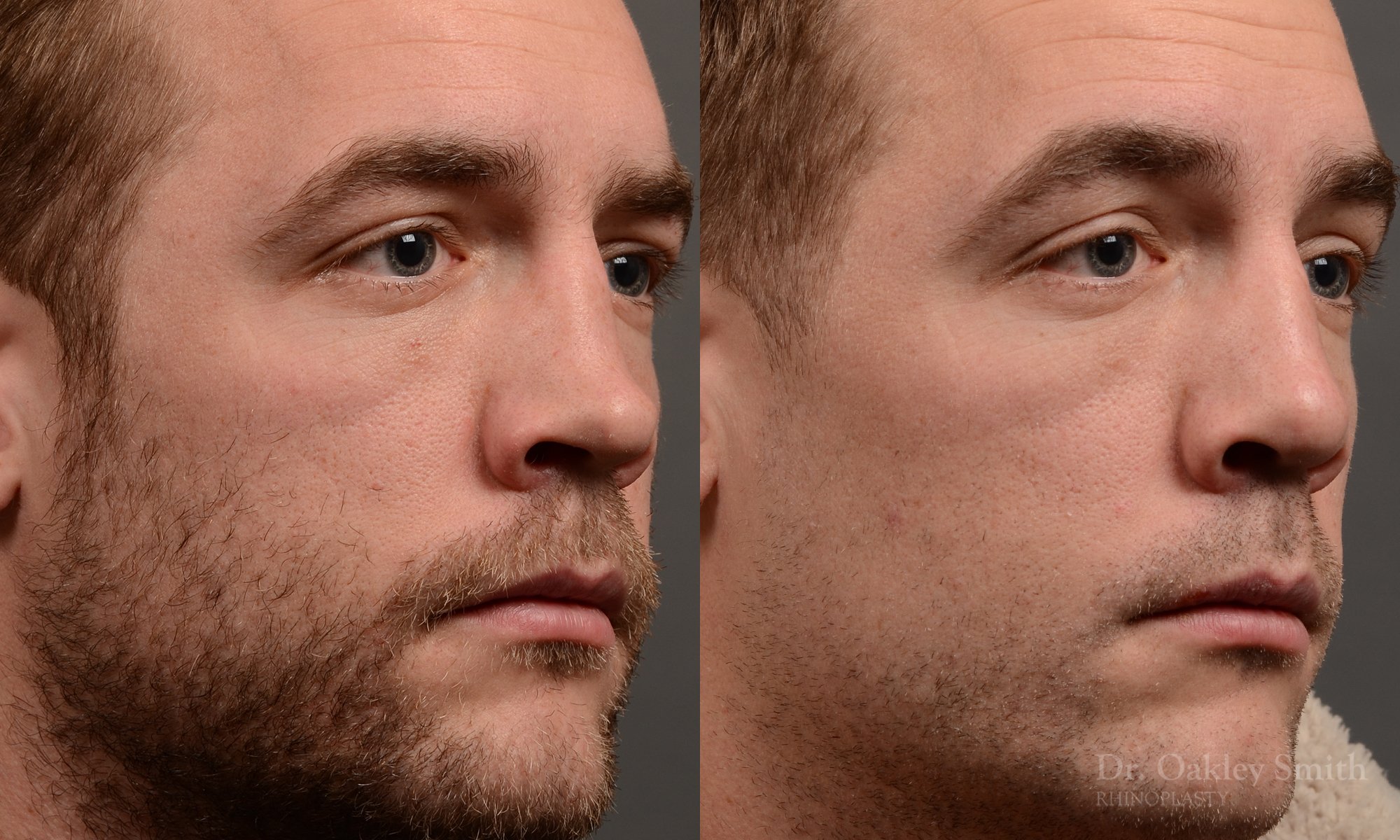 388 - expert toronto rhinoplasty surgery to remove the bulbous tip of this mans nose
