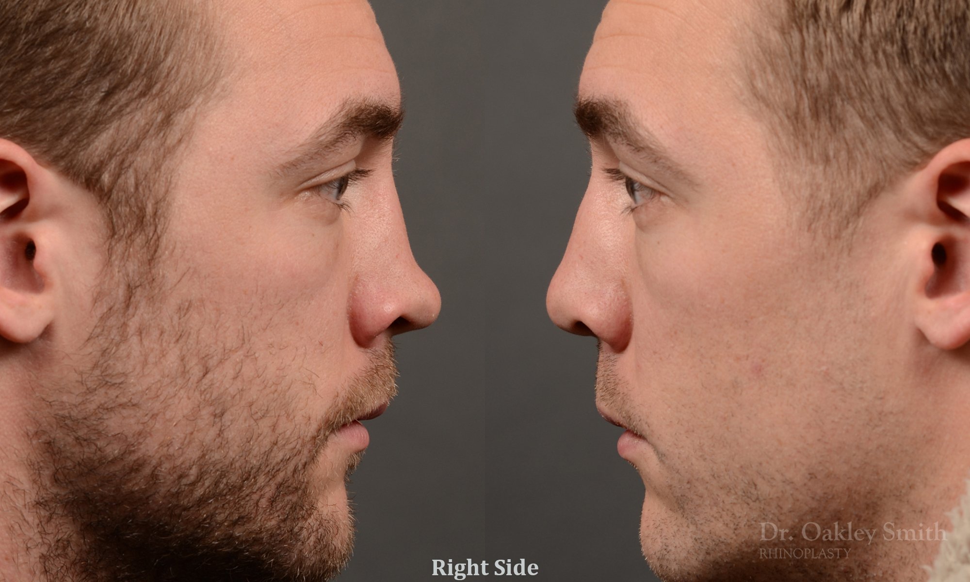 388 - expert toronto rhinoplasty surgery to remove the bulbous tip of this mans nose