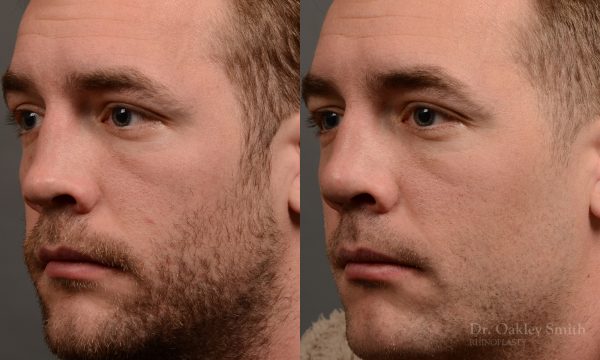 388 - expert toronto rhinoplasty surgery to remove the bulbous tip of this mans nose