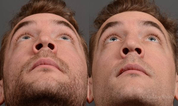 388 - expert toronto rhinoplasty surgery to remove the bulbous tip of this mans nose